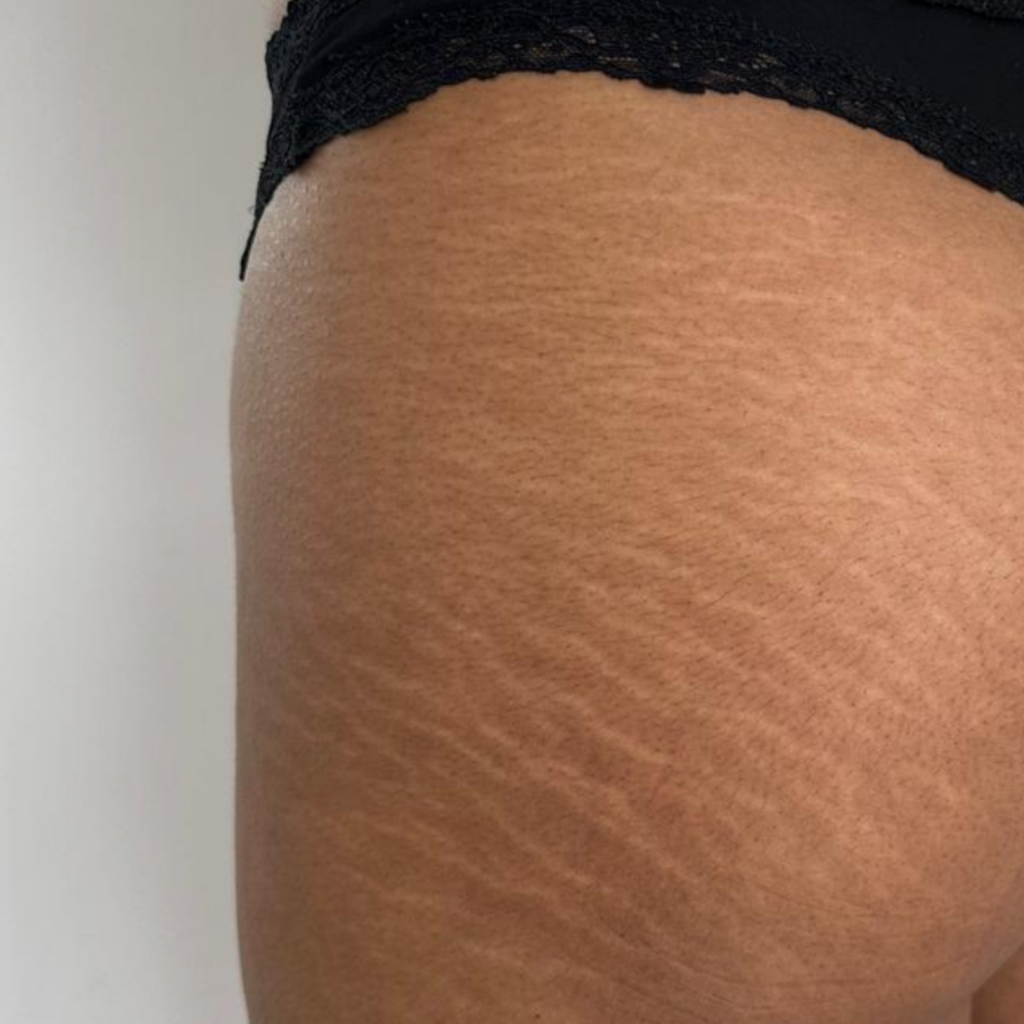 Scar camouflage tattoo treatment Dublin