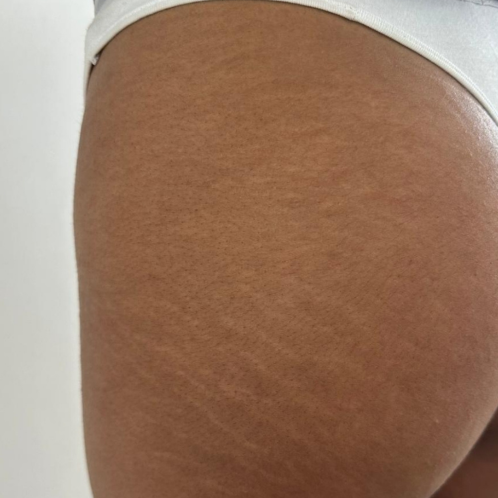 Stretch mark camouflage tattoo Swords