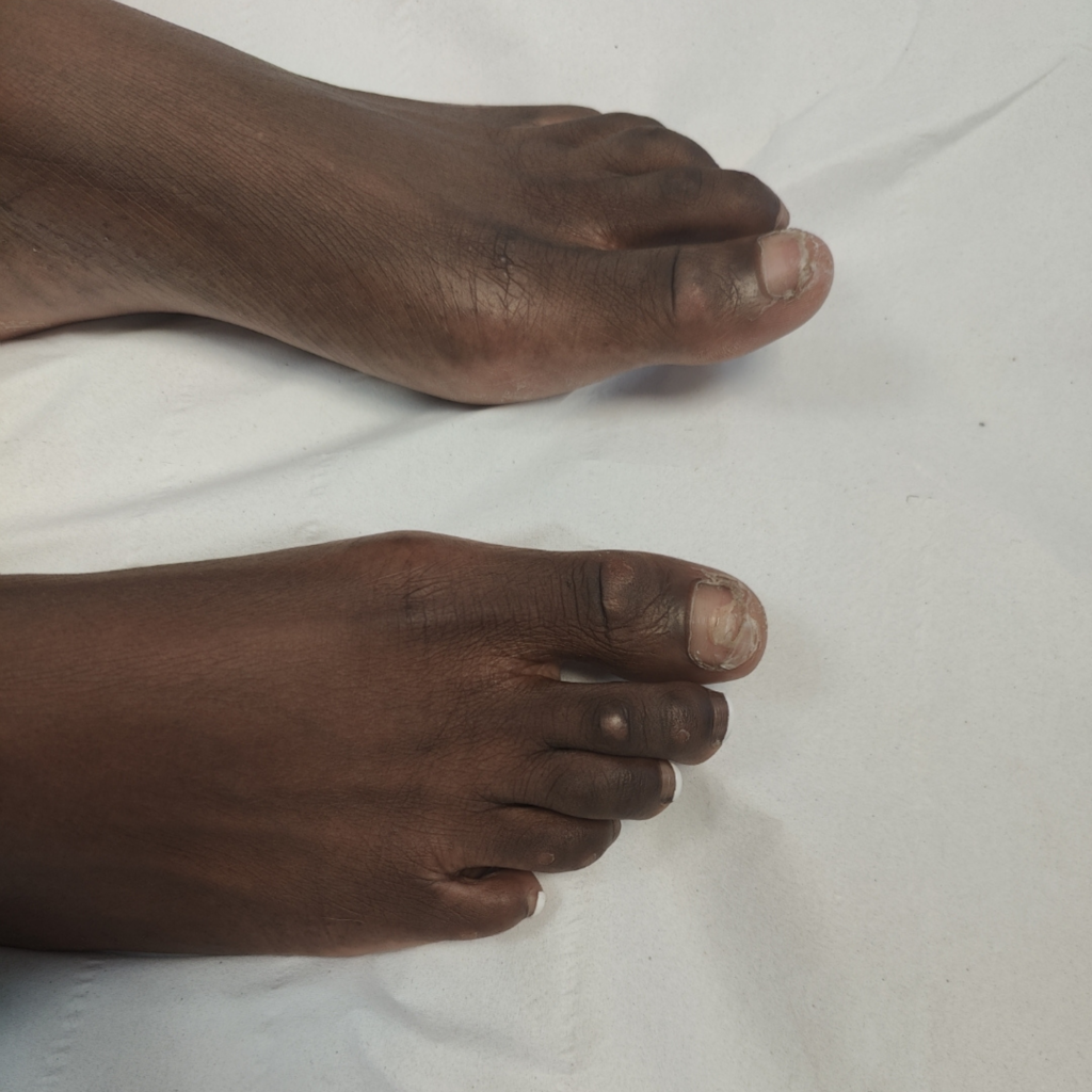 Corrective pigment camouflage for scars